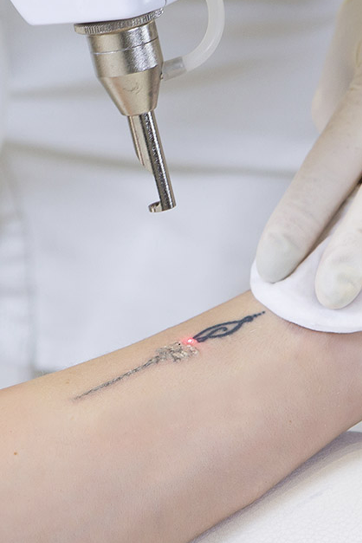 Impaired tattoo... - International Journal of Dermatology | Facebook